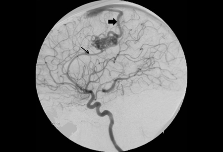 Cerebral arteriovenous malformation images