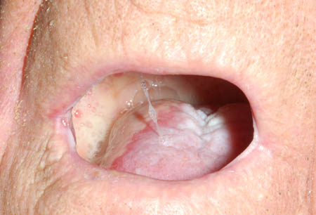口腔黏膜炎 images