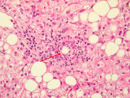 Coxiella burnetii infection images