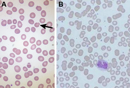 Hereditary Spherocytosis - Symptoms, Diagnosis And Treatment | BMJ Best ...