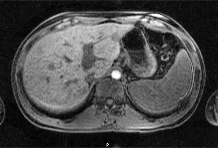 Bartonella infection images