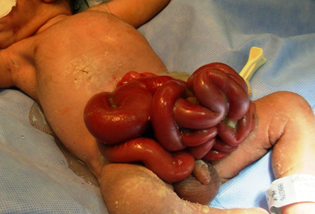 Omphalocele and gastroschisis images