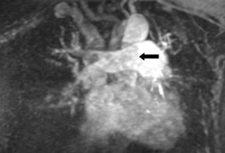 Embolia pulmonar images