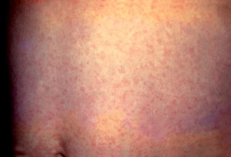 Rubella images