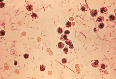 Shigella infection images