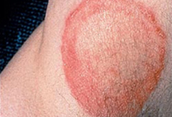 Dermatophyte infections images