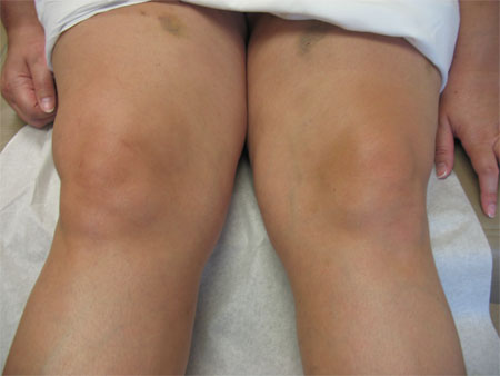 knee inflammation swelling