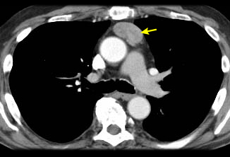 Tumor tímico images