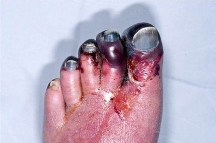 Heparin-induced thrombocytopenia images