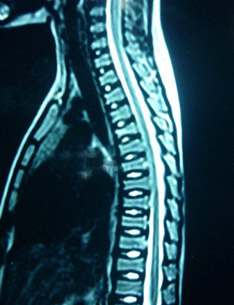 Hypercalcaemia of malignancy images