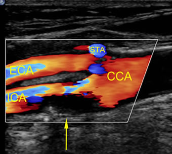 Carotid artery stenosis images