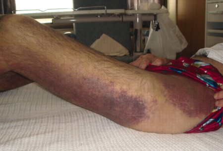 Assessment of easy bruising images