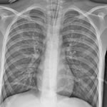 Enterovirus D68 images