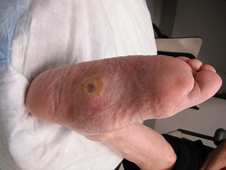 Diabetes-related foot disease images