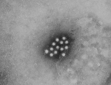 Hepatitis A images