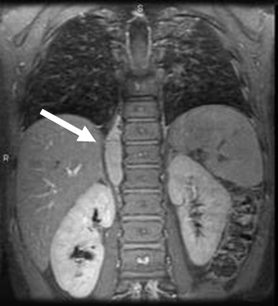 Neuroblastoma images