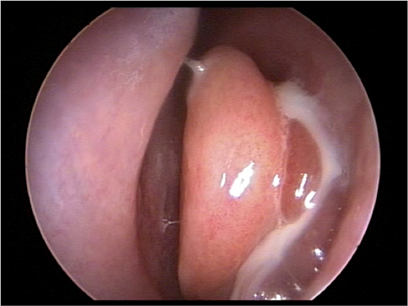 Acute rhinosinusitis images