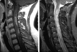 Multiple sclerosis images