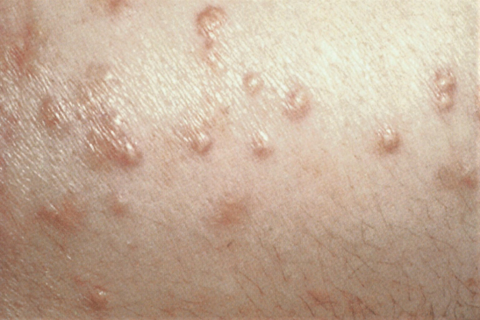 Hipertrigliceridemia images