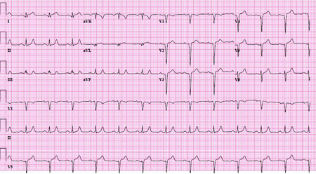 ST-elevation myocardial infarction - Diagnosis Approach | BMJ Best ...