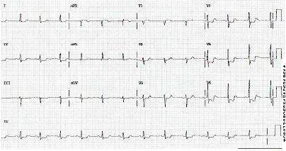Non-ST-elevation myocardial infarction images
