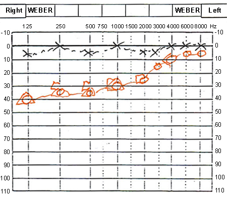 Meniere's disease images