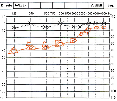 Weber audiométrico, o que é?