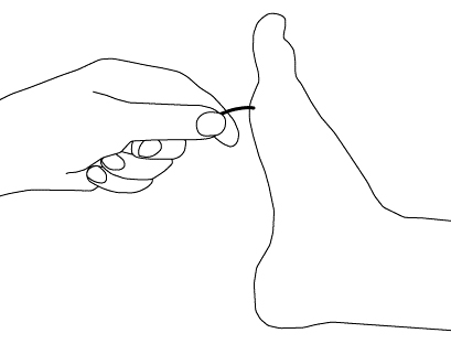 Evaluation of polyneuropathy images