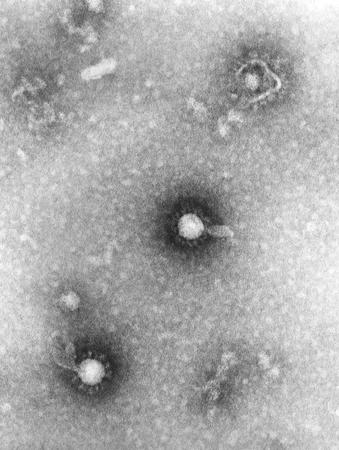 Eastern equine encephalitis virus infection images