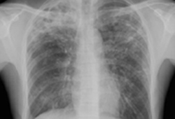 Pulmonary tuberculosis images