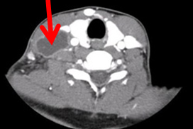 Tuberculosis extrapulmonar images