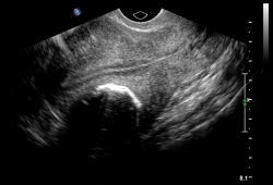 Evaluation of abnormal uterine bleeding images