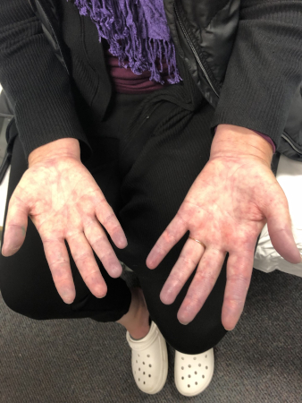 Raynaud phenomenon images