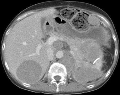 Cushing syndrome images