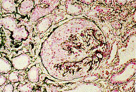 Glomerulonephritis images