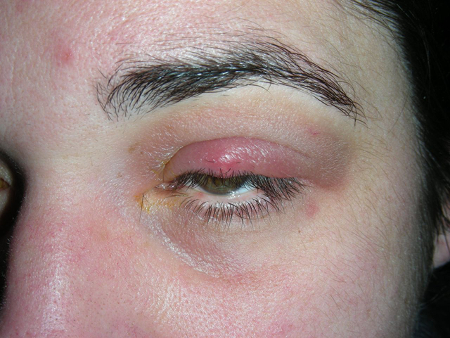 Stye and chalazion images