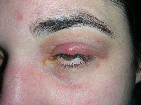 Clínica de olhos Levate - 👀 Terçol ou Hordéolo: 1. O que é? Pequeno nódulo  infeccioso na região palpebral, mais precisamente na base dos cílios.  Geralmente ocorre por uma obstrução das glândulas