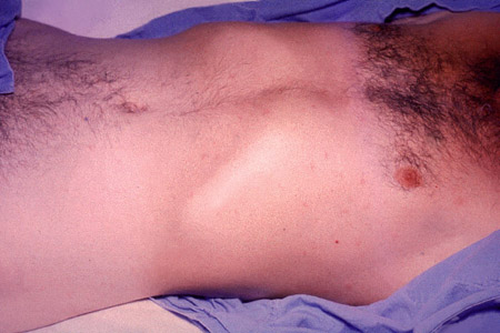 Typhoid (enteric) fever images