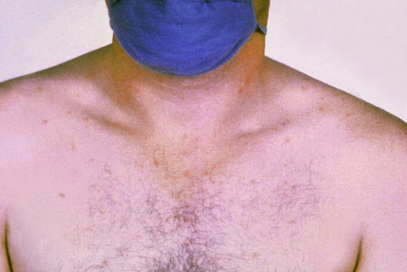 Febre tifoide (entérica) images