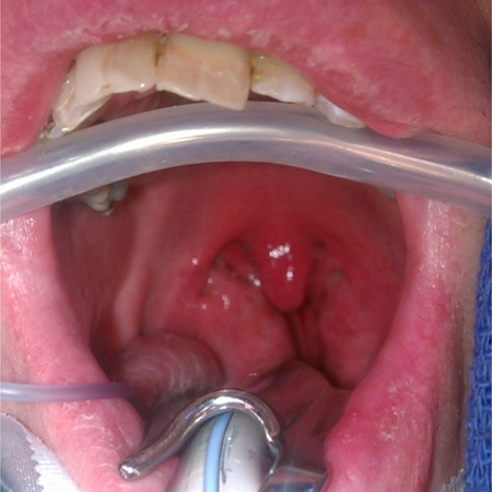 Assessment of dysphagia images