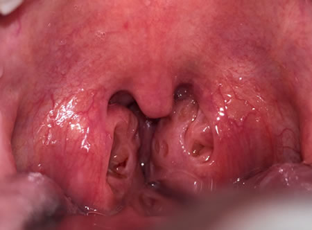 Evaluation of dysphagia images