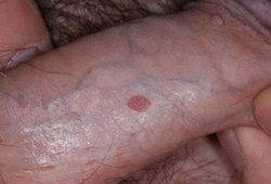 pearly penile papules vs genital warts