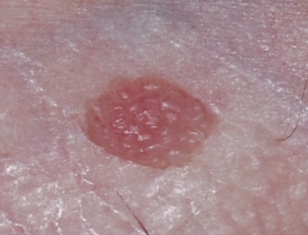 pearly penile papules vs genital warts