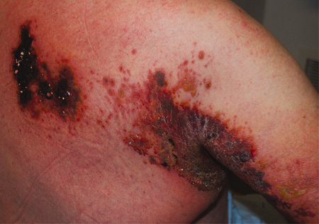 Infecção por herpes-zóster images