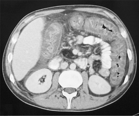 Clostridioides difficile-associated disease images