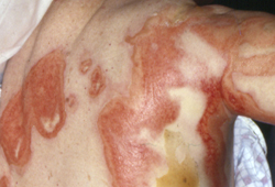Stevens-Johnson syndrome and toxic epidermal necrolysis images