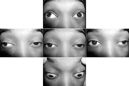 Myasthenia gravis images