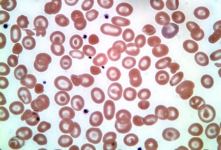 Alpha-thalassemia images