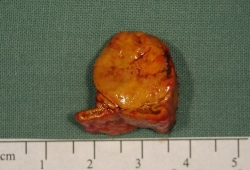 Primary aldosteronism images