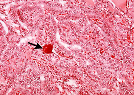 Thyroid cancer images